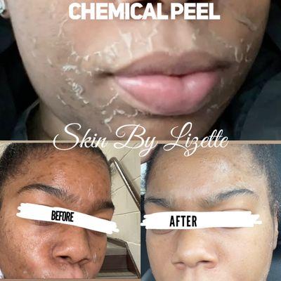 Before and after of a Chemical peel