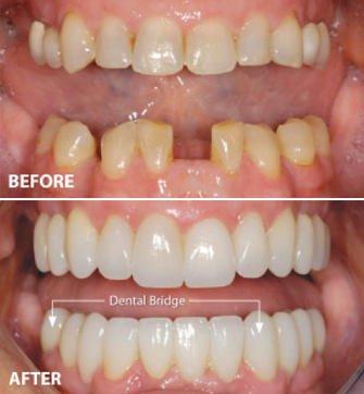 Before and After at NÜVA Smile | Wyckoff, NJ