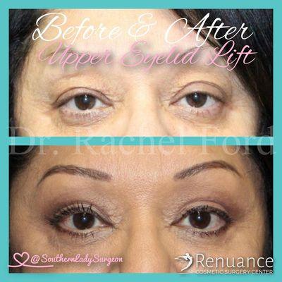 Before and after upper eyelid lift