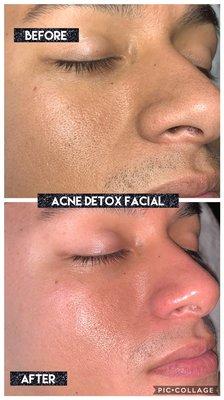 Pore Detox Facial. Look at the pore clearing of the nose. This was after the 1st of at least 2 or 3 treatments to come.