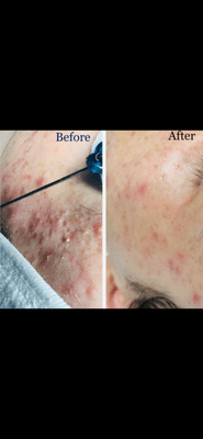 Say your acne goodbye with amazing Acne Facial and complementary professional advice for home care routine