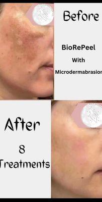 BioRePeel (All Season Chemical Peel) with Microdermabrasion