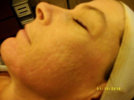 Before Microderm/Microneedling Treatment