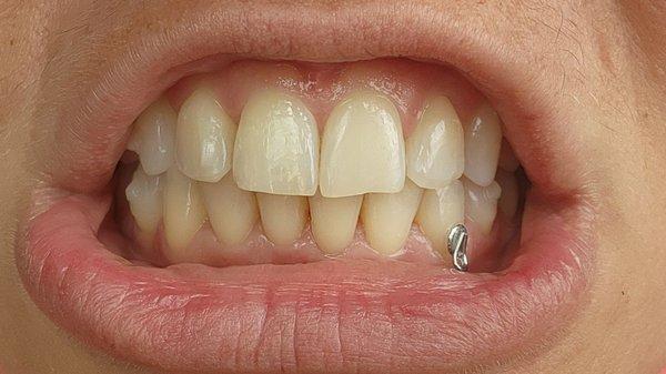 Drilled teeth