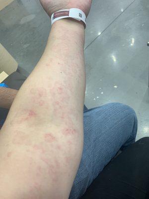 Hives from allergic reaction to antibiotic