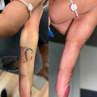 Before and after Laser Tattoo Removal