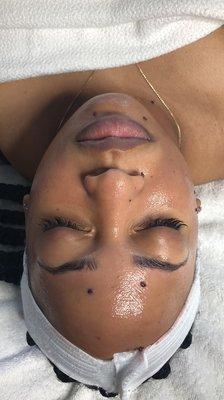 Enzyme Treatment for pigmentation!