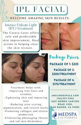 IPL Facial Promotion