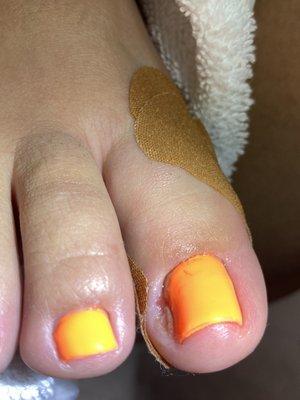 Infection from ivy nails