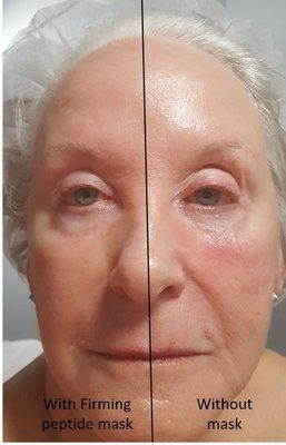 Before and after with our Firming peptide mask treatment.