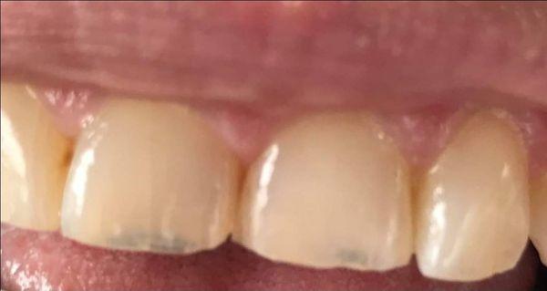 And you can see Dr. Shinde's work here. Beautifully done.  He saved my tooth and my smile