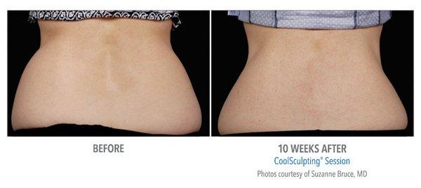 Check out these amazing Coolsculpting results!