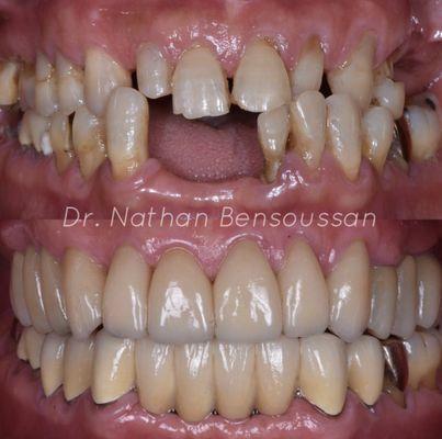 This patient received a full mouth rehabilitation with a combination of implants, crowns, veneers and bridges.