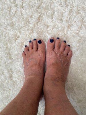 My feet after a week and half