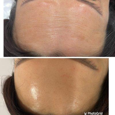 Skin Botox before and after contrast