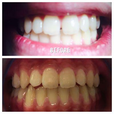 3 months Fastbraces!