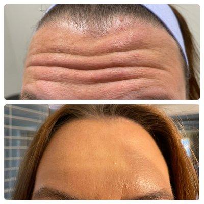 View our Botox results at The Confidence Lab.