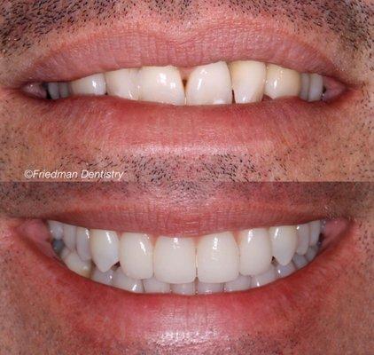 Dr. Matt provided Invisalign®, implants, and implant supported crowns to achieve this result.