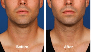 Kybella before and after