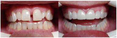 Porcelain Crowns