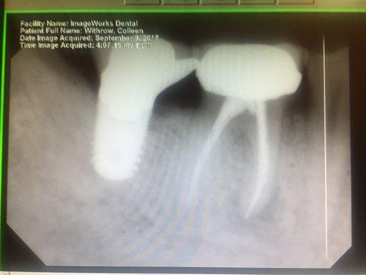 Root canals and retreat, implant placements and restoration all done in one office