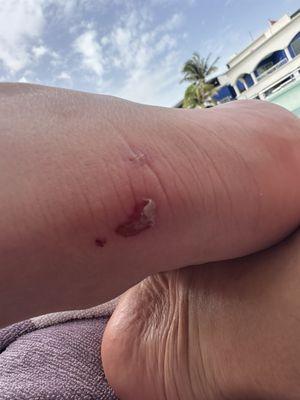 Blisters caused by water shoes