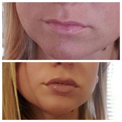 Lip fillers before and after