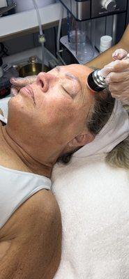 Radiofrequency facial