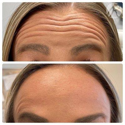 Botox results