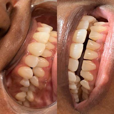 Results of 30 minute cosmetic teeth whitening.