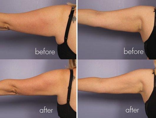 Before & After arm photos with sculpting methods.