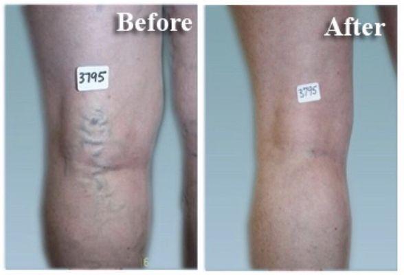 Along with other treatments, ambulatory phlebectomy is performed to help treat and remove bulging veins.