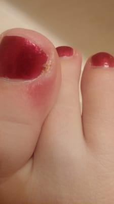 Picture of infected toe