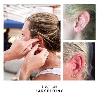 Earseeding stimulates acupressure points on the ear with tiny 24k gold plated seeds secured to the ear.