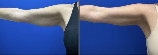 Non-invasive contouring of the arms using our EMSCULPT NEO. These impressive results are only after two of the recommended four sessions.