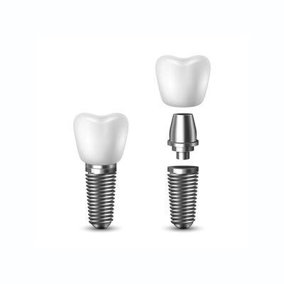 Single tooth implants are the best way to repair damaged or missing teeth in a localized area.