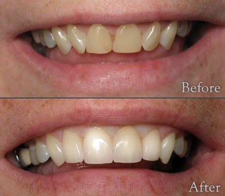 Porcelain Veneers