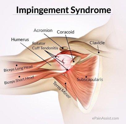 We know how much your shoulders hurt ALL the time... see how we can not only get rid of the pain but correct it long term!