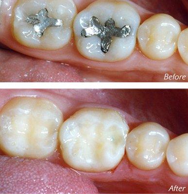 White color composite fillings