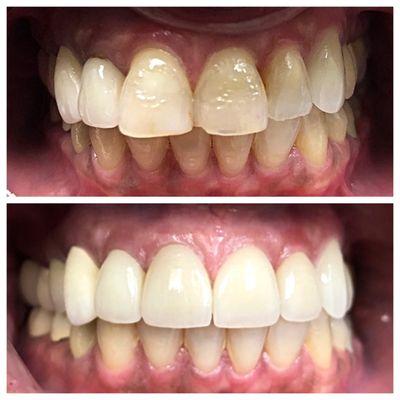 Patient came in to see Dr. Akhavan because she was very unhappy with her smile. Dr. Akhavan was able to transformed her smile using veneers.