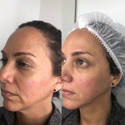 HIFU skin tightening