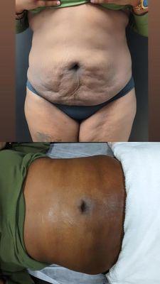 Break down stubborn fatty tissues in the abdomen, reduce the appearance of cellulite