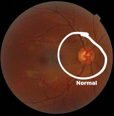 A normal optic nerve