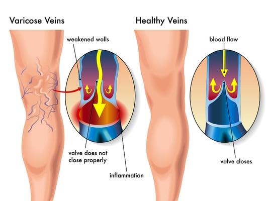 Denver Vein Center