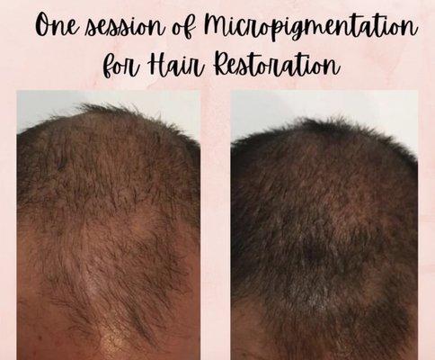 Hair restoration