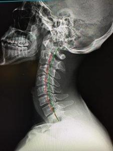 X-ray after