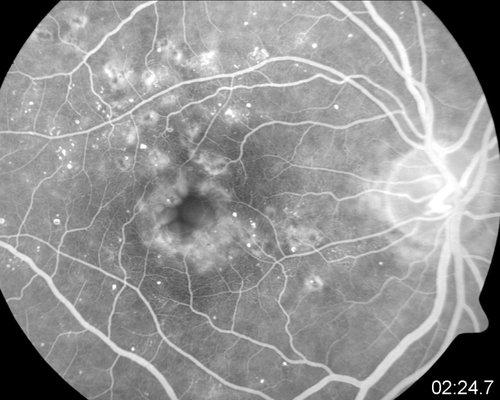 Right eye, Diabetic Retinopathy