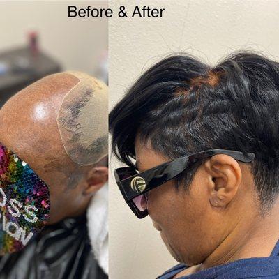 Before & After: Non-Surgical Hair Replacement Unit