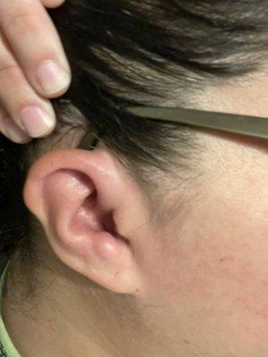 Right Ear 12 Hours After Removal