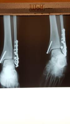 Yes - they CAN help you over come a Trimalleolar Fracture of the ankle like this!